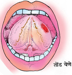 Mouth Stomatitis